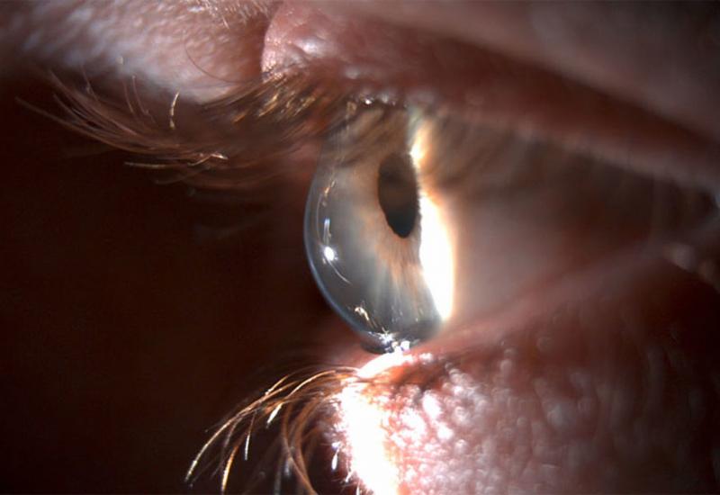 Zdravlje očiju: Šta je keratokonus i kako se liječi?